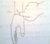 Hình 61 3 Ấn vào ổ gãy đa Hình 61 4 Hình lưng đĩa Hình 61 5 Hình lưỡi lê 3 2 4 X 2