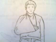 Hình 61 6 Cố định và treo tay tư thế cơ năng bột Phóng bế Novocain 0 5 –1 tại 5