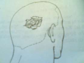 Hình 61 4 Chấn thương sọ não kín có rách da đầu 1 5 Vỡ xương sọ Lún xương 8