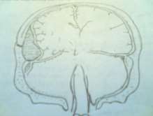 Hình 62 5 Hình cắt dọc máu tụ trong sọ 3 Xử trí ở tuyến y tế cơ sở Khi 9