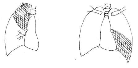 Hình 4 1 Ảnh viêm thuỷ trên Hình 4 2 Ảnh viêm thuỳ dưới Xét nghiệm máu BC tăng 1