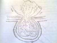 Hình 65 1 Ruột bị nghẹt hình chữ W Hình 65 2 Tắc ruột do dính 2 Nguyên nhân Có 1