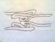 Hình 66 3 Lồng ruột kép 1 Triệu chứng 1 1 Triệu chứng cơ năng 1 1 1 Đau bụng 10