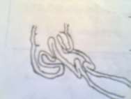 Hình 66 3 Lồng ruột kép 1 Triệu chứng 1 1 Triệu chứng cơ năng 1 1 1 Đau bụng 11