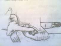 Hình 66 5 Thăm trực tràng có máu theo tay 1 3 Triệu chứng toàn thân Dấu hiệu mất 12