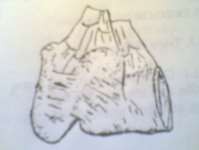 Hình 65 1 Ruột bị nghẹt hình chữ W Hình 65 2 Tắc ruột do dính 2 Nguyên nhân Có 2