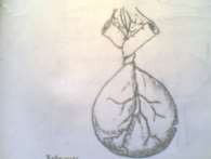 Hình 65 3 Xoắn ruột Hình 65 4 Tắc ruột do dây chằng 2 2 Tắc ruột cơ năng Điều 3