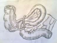 Hình 65 3 Xoắn ruột Hình 65 4 Tắc ruột do dây chằng 2 2 Tắc ruột cơ năng Điều 4