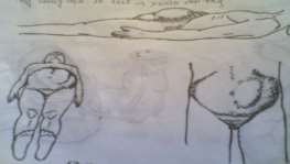 Hình 65 6 Chướng bụng do tắc ruột 3 3 Triệu chứng toàn thân Nếu bệnh nhân 6