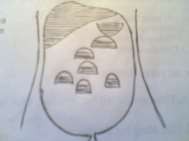 Hình 65 7 Hình ảnh mức nước mức hơi 4 Chẩn đoán 4 1 Chẩn đoán xác định 7