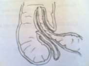 Hình 66 1 Lồng ruột đơn Hình 66 2 Lồng manh hồi tràng Hình 66 3 Lồng ruột kép 1 9