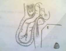 Hình 67 1 Thành phần túi thoát vị Hình 67 2 Thành phần bao thoát vị 2 1 Ống bẹn 2