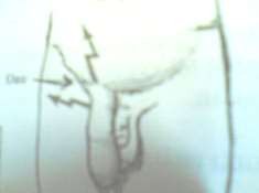 Hình 67 3 Thoát vị nghẹt phải mổ cấp cứu 3 2 Triệu chứng thực thể 3 2 1 Nhìn 4