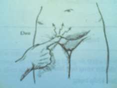 Hình 67 4 Thoát vị đùi nghẹt ở nữ phải mổ cấp cứu 3 3 Triệu chứng toàn 5