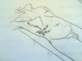 Hình 68 1 Viêm màng bụng do dập vỡ thận Lá thành bị thủng ví dụ Dao đâm 6