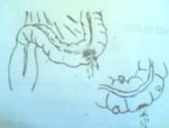 Hình 68 2 VMB do thủng đại tràng Hình 68 3 VMB do chửa ngoài tử cung vỡ 2 2 2 Qua 7