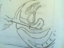 Hình 68 4 VMB do hoại tử mật Hình 68 5 Viêm màng bụng do nạo thai 3 Triệu chứng 9