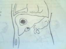 Hình 72 1 Ổ áp xe gan ở thùy phải 1 Nguyên nhân Bệnh gặp ở nam nhiều hơn nữ 5