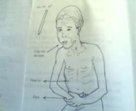 Hình 72 2 Đau bụng Đau là dấu hiệu quan trọng Đau nhất là ở liên sườn 8 – 9 1