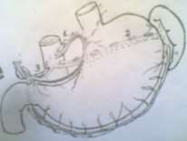 Hình 74 1 Bạch huyết dạ dày Hình 74 2 Ung thư dạ dày 1 1 Khối u Nhìn bề ngoài 10