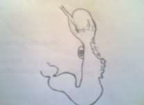 Hình 74 1 Bạch huyết dạ dày Hình 74 2 Ung thư dạ dày 1 1 Khối u Nhìn bề ngoài 11