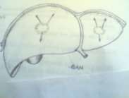 Hình 72 5 Các hướng vỡ của áp xe gan 5 1 Ổ áp xe vỡ qua cơ hoành vào màng phổi 4