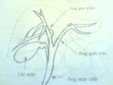 Hình 73 1 Đường dẫn mật Hình 73 2 Sỏi đường mật 2 Triệu chứng 2 1 Triệu 5