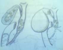 Hình 73 1 Đường dẫn mật Hình 73 2 Sỏi đường mật 2 Triệu chứng 2 1 Triệu 6