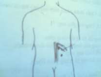 Hình 73 4 Gan to Hình 73 5 Điểm sườn lưng 2 4 Xét nghiệm Bilirubin máu tăng Muối 9