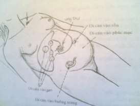 Hình 74 4 Di căn của ung thư dạ dày 4 Xử trí 4 1 Cần phát hiện ngay ở giai 1