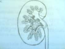 Hình 75 1 Sỏi đài bể thận Hình 75 2 Đái máu hoặc tắc đái khi vận động 4 2