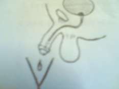 Hình 77 1 Sỏi nằm cổ bàng quang Hình 77 2 Sỏi nằm gần đáy bàng quang Bệnh nhân 1