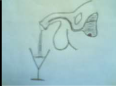 Hình 77 1 Sỏi nằm cổ bàng quang Hình 77 2 Sỏi nằm gần đáy bàng quang Bệnh nhân 2