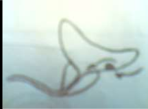 Hình 77 3 Nghiệm pháp 3 cốc Hình 77 4 Sỏi bàng quang đái máu cuối bãi 3 3 Triệu 4