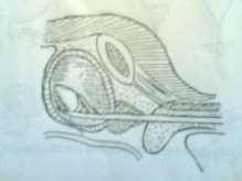 Hình 77 5 Tán sỏi bàng quang 5 2 Khi có biến chứng như tắc đái Nếu có điều 5