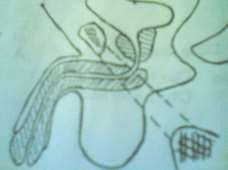 Hình 78 1 Niệu đạo đáy chậu giữa xương mu và vật cứng 3 Triệu chứng 3 1 6