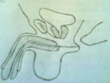 Hình 78 2 Đứt niệu đạo sau 2 1 Triệu chứng toàn thân Tình trạng toàn thân khá 7