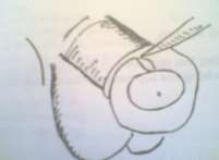 Hình 79 1 Cắt vòng thắt nghẹt bao quy đầu 4 1 Hẹp bao quy đầu Phải phẫu thuật 8