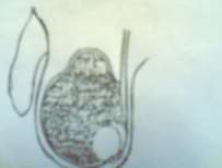 Hình 81 1 Tràn dịch màng tinh hoàn 1 2 Hình 81 2 Tràn dịch màng tinh hoàn bẩm sinh 1 1