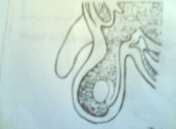 1 2 Hình 81 2 Tràn dịch màng tinh hoàn bẩm sinh 1 Loại thông cả hai đầu 2 Loại 2