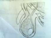 1 2 Hình 81 2 Tràn dịch màng tinh hoàn bẩm sinh 1 Loại thông cả hai đầu 2 Loại 3