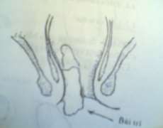 Hình 8 2 1 Tĩnh mạch trực tràng Hình 82 2 Búi trĩ Trĩ được chia ra Trĩ nội Búi 5