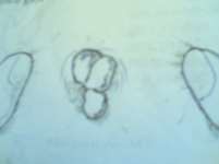 Hình 82 3 Trĩ ngoại Hình 82 4 Viêm loét búi trĩ 1 2 Triệu chứng thực thể Khám ở 6