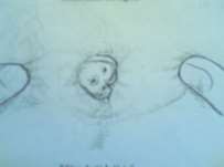 Hình 82 3 Trĩ ngoại Hình 82 4 Viêm loét búi trĩ 1 2 Triệu chứng thực thể Khám ở 7