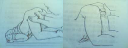 Hình 82 5 Tư thế khám trĩ Hình 82 6 ống soi hậu môn Hình 82 7 Soi hậu môn 1 3 Khám 8