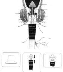 Hình 82 8 Phẫu thuật Longo Khâu treo trĩ bằng tay Đây là phương pháp cải biên 1