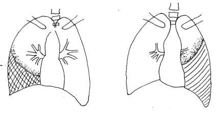 Hình 6 1 Ảnh tràn dịch màng phổi phải 1 và trái 2 4 Chọc dò màng phổi có hai 1