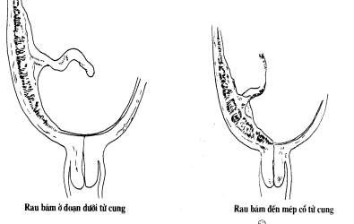 Hình 89 1 Vị trí rau tiền đạo 3 Nguyên nhân Chưa rõ ràng Một số yếu tố 1