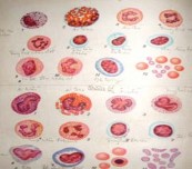 Bạch cầu ái toan tăng những bệnh quá mẫn bệnh ngoài da bệnh do ký sinh trùng 1