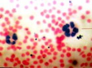 ấ u c ầ u Là giai đoạn trung gian của tủy cầu và bạch cầu ái trung nhân gậy 3